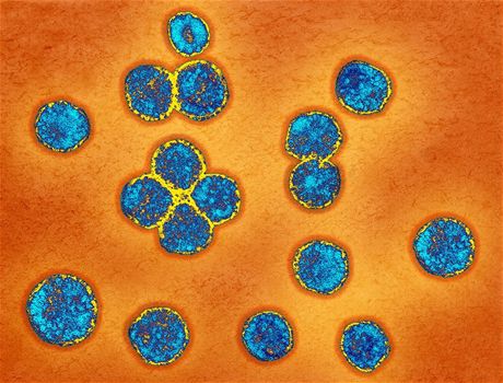 Nový koronavir se podobá SARS (na snímku). Doposud si vyádal jedenáct ivot. Ilustraní foto