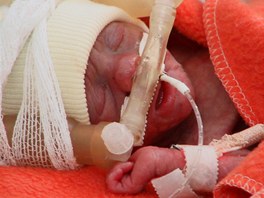 Pednosta Kliniky neonatologie Dtské fakultní nemocnice v Koicích MUDr. Peter...