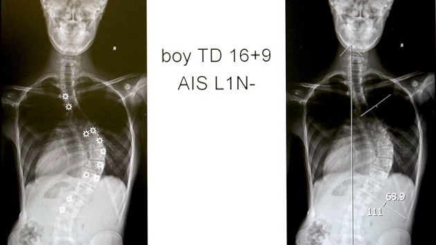 Lkai z Fakultn nemocnice Brno operuj dtskou skolizu ptee pevratn etrnou metodou. Pruty, kter dtem rovnaj pte, toti rostou spolu s nimi.