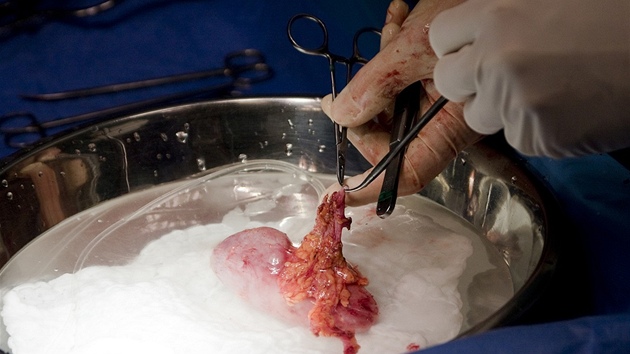 Prask IKEM provd transplantace ledvin od ivch drc. Na obrzku je orgn bezprostedn po vyoperovn z tla pacienta. 