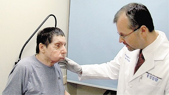 Prvním pacientem, kterému chirurg Bohdan Pomaha transplantoval obliej, byl