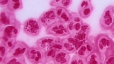 Bakterie Neisseria gonorrhoeae způsobuje kapavku. Bakterie Neisseria gonorrhoeae způsobuje kapavku.