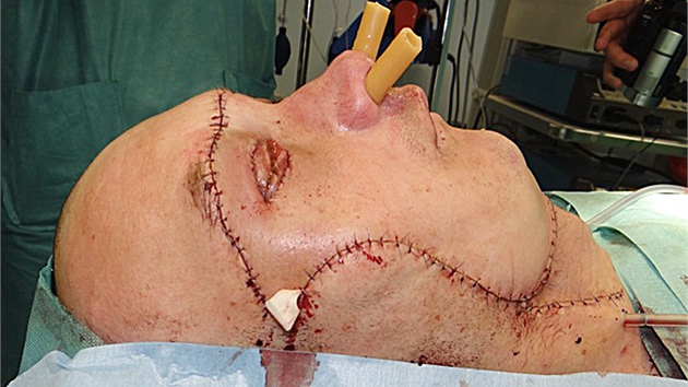 Tiaticetilet Polk, ktermu ezaka kamene amputovala cel obliej, po spn operaci (22. kvtna 2013)