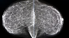 Snímek obou prs poízený mamografem, který budou nezávisle na sob kontrolovat