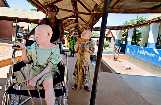 V Tanzanii se orgány dtí postiených albinismem pouívají pro kouzlení a...