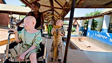 V Tanzanii se orgány dětí postižených albinismem používají pro kouzlení a... V Tanzanii se orgány dětí postižených albinismem používají pro kouzlení a...