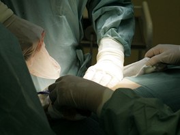 Vytaený dutý implantát (expandér), který byl doasn vloen do prsu pacientce...