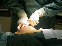 Léka musí optimální umístní implantátu v prsu doladit prsty.