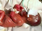 Pedasn narozené dít v inkubátoru. Ki chybí epidermis a je velmi citlivá.