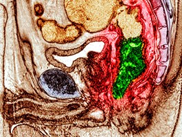 Snímek z magnetické rezonance, kde je zelen oznaena rakovina koneníku, která...