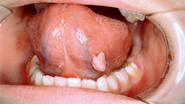 Bradavice na spodn stran jazyka, za kterou me infekce zpsoben lidskm papilomavirem (HPV).