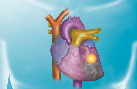 Na srdce postiené infarktem lékai pouijí záplatu nebo gelové lepidlo. Metoda je vhodná pro mladí pacienty, Contipro se snaí najít materiál, který by pomohl i tm díve narozeným. (Ilustraní snímek)