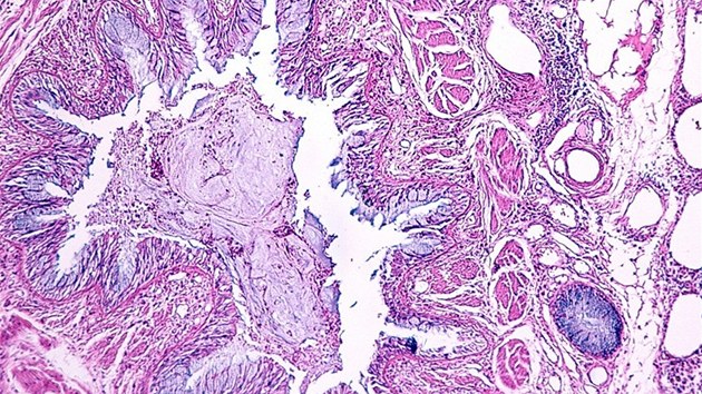 Bronchiální astma v plicní části. Silné astma může mít na svědomí předčasné úmrtí. I tady je častým důvodem právě kouření.