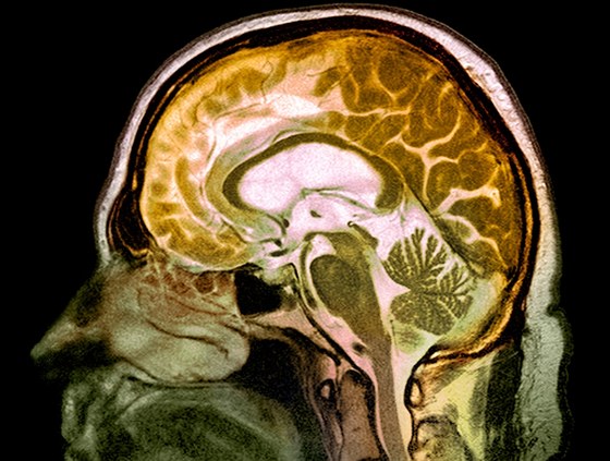 Snímek z magnetické rezonance, na kterém je vidt mozek pacienta s alkoholovou demencí.