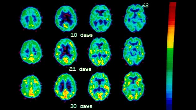 Pozitronov emisn tomografie (PET) mozku, kde je vidt, jak se postupn zvyuje innost mozku (lut vyznaeno) u alkoholika po abstinenci. V horn sti jsou snmky mozku po abstinenci 10 dn, uprosted 21 dn a ve spodn sti po msci bez alkoholu.