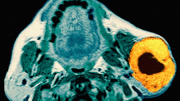 Snmek z magnetick rezonanace, na kterm je vidt hlava pacienta s velkm ndorem na pun slinn lze.
