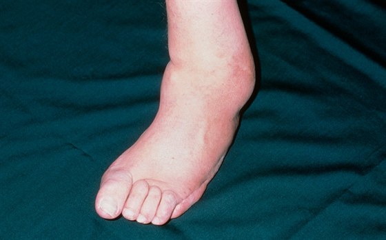 Zdeformovaná noha pacienta s neuropatií.