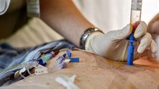 Nic moc. Odběr kostní dřeně není příjemný, díky přesnosti lékařů ale trvá velmi Nic moc. Odběr kostní dřeně není příjemný, díky přesnosti lékařů ale trvá velmi