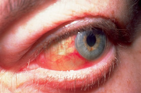 Zdravé oko by mlo mít bílou barvu (ilustraní snímek)