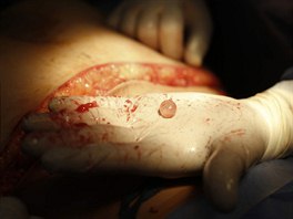 Chirurg drí v ruce silikonovou kuliku, která se pod kí vytvoila. 