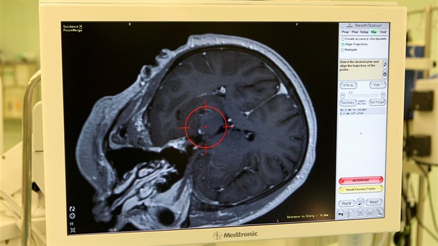 Proti Parkinsonov chorob bojuj olomout chirurgov uniktn operac, pi kter pacientovi za plnho vdom voperuj do mozku elektrody. Pomohou tak zmrnit pznaky, na kter ji lky nesta. (23. ledna 2014)