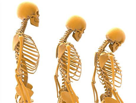 Osteoporóza se projevuje také zmenením tlesné výky (ilustraní snímek)