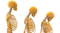 Osteoporóza Osteoporóza