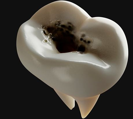 Ped zubním kazem vás ochrání jen správná pée o chrup (ilustraní snímek)