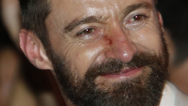Hugh Jackman ukzal jizvu po odstrann ndoru na nose (Singapur, 14. kvtna 2014).