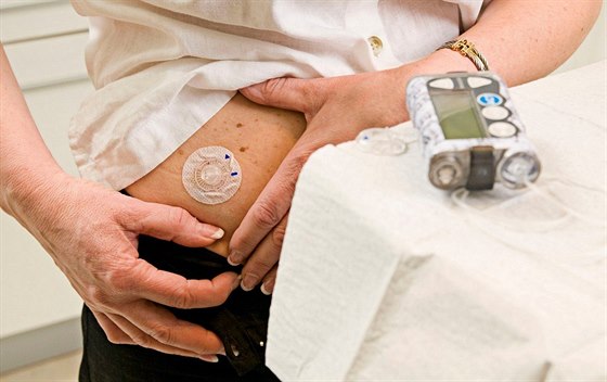 Inzulinovou pumpu pouívají lidé s cukrovkou prvního typu. Ta je vrozená a diagnostikována bývá i malých dtí. Ilustraní foto