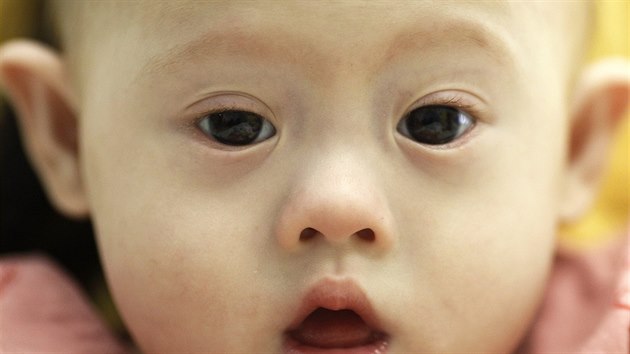 Gammy se narodil s Downovm syndromem (3. srpna 2014).