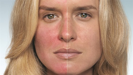 Stále ervený obliej je píznakem nemoci zvané rosacea.