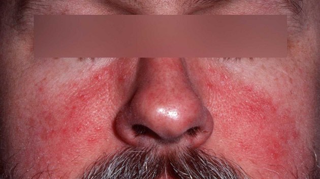 Rosacea trp i mue.