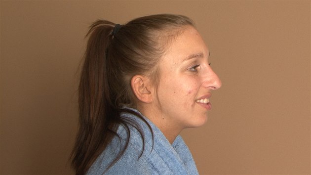Pacientka ped plastickou operac nosu.