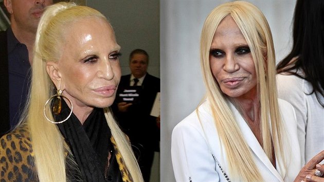 Donatella Versace si nechala vyehlit obliej (vlevo snímek z listopadu a...