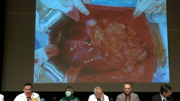 Lkai z IKEM pacientovi transplantovali pt orgn najednou.