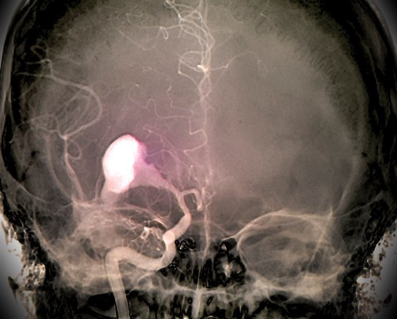 Snímek mozku mladého pacienta se subarachnoidálním krvácením. To zpsobilo...