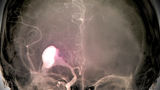 Snmek mozku mladho pacienta se subarachnoidlnm krvcenm. To zpsobilo praskl aneurysma.
