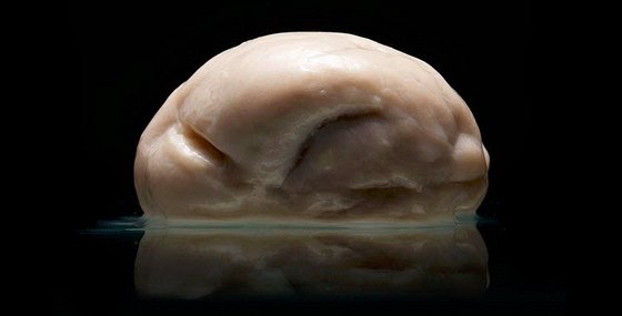 Mozek neznámého pacienta postieného tkou formou tzv. lissencefalie. Je zcela hladký, bez záez a závit, které mozku dávají jeho charakteristický vzhled, ale i schopnosti.