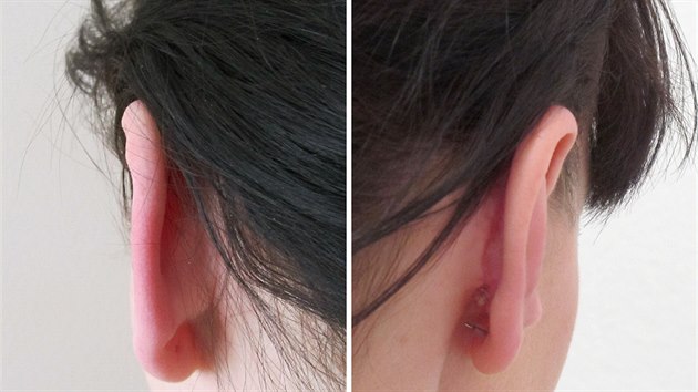 Bino ucho ped operac a pr tdn po operaci.