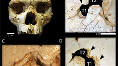 Detailní pohled na lebku ukazuje dv rány zpsobené s nejvtí pravdpodobností...