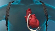 Novou srdeční pumpu HeartMate III. má v Česku už deset pacientů. Díky přístroji... Novou srdeční pumpu HeartMate III. má v Česku už deset pacientů. Díky přístroji...