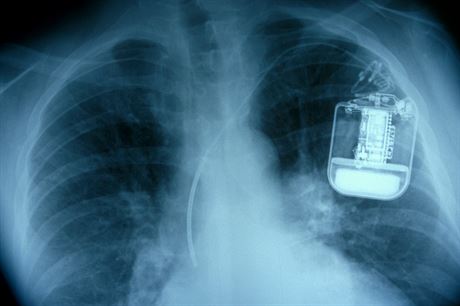 Smartphony mohou nepízniv ovlivovat kardiostimulátor. Ilustraní snímek