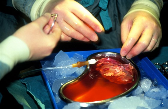 Transplantace ledviny (Ilustraní fotografie)