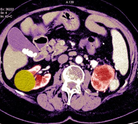 Snmek z potaov tomografie, kde je vidt ndor ledviny (lutozelen barva)....