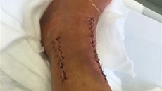 Levá noha Filipa Podmola krátce po operaci