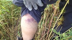 Zranění jednoho ze sběračů, které mu měl údajně způsobit nešetrný zásah policie. Zranění jednoho ze sběračů, které mu měl údajně způsobit nešetrný zásah policie.