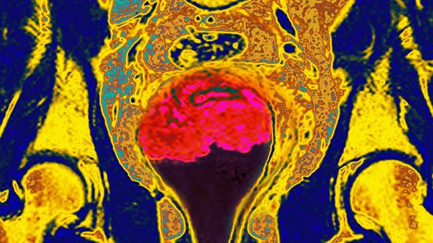 Snmek z magnetick rezonance ukazuje nlez rakoviny dlonho pku (rov barva uprosted).
