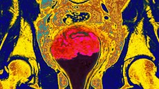 Snímek z magnetické rezonance ukazuje nález rakoviny dloního ípku (rová...