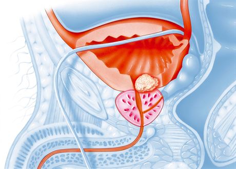 Rakovina prostaty, která je na obrázku uprosted, postihuje pedevím mue po...